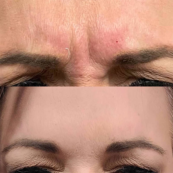 optimal-gallery-7 A woman's forehead showing results from Botox in Spring, TX.