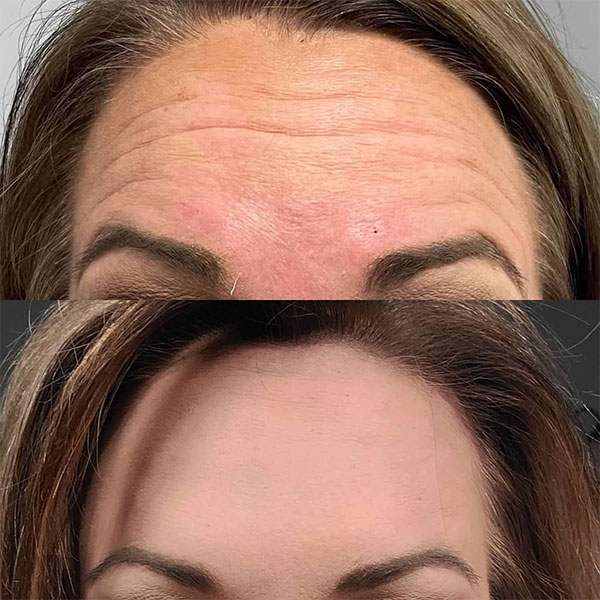 optimal-gallery-8 A woman's forehead showing results from Botox in Spring, TX.