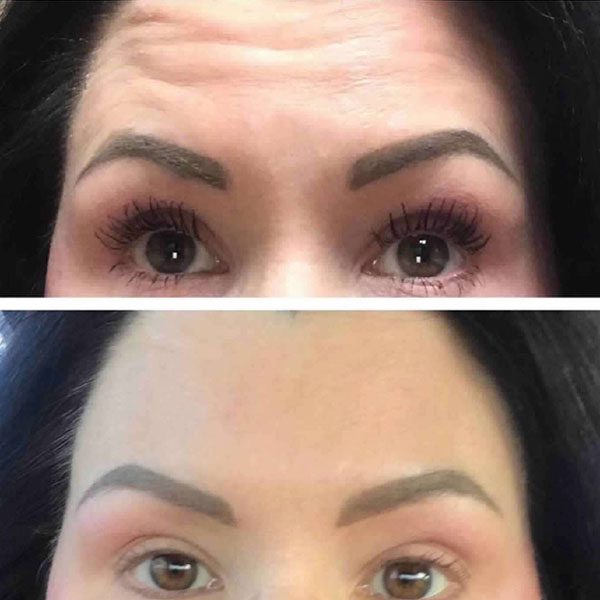 botox-6 A woman's forehead showing results from Botox in Spring, TX.